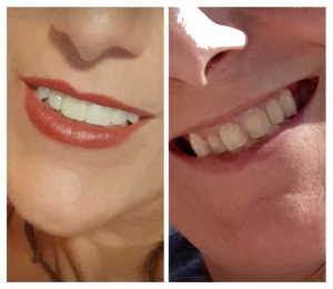 Faccette dentali Lumineers - Dentista Roma