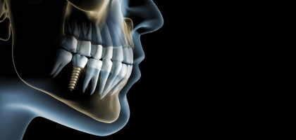 Impianti dentali dentista roma